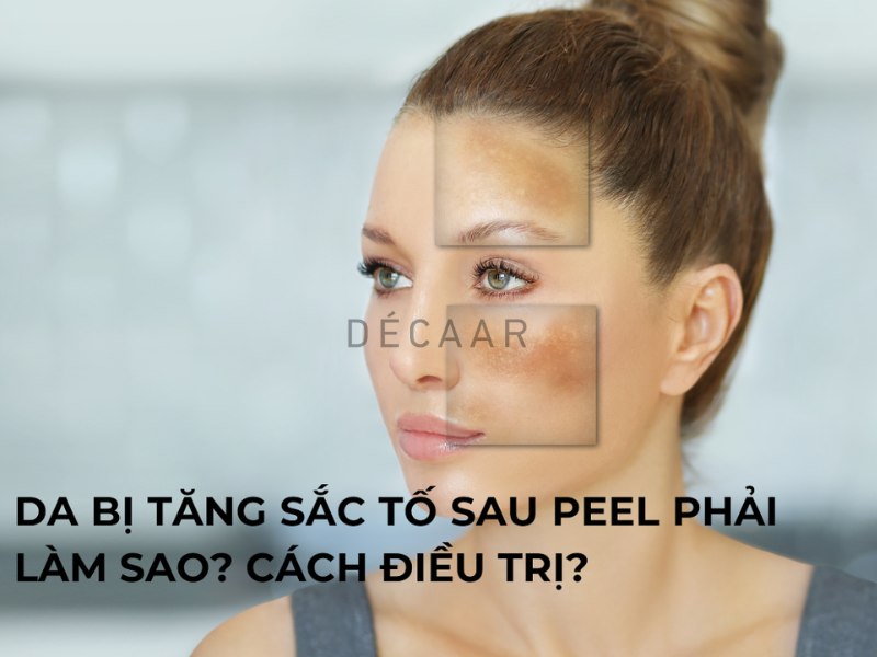 da bị tăng sắc tố sau peel